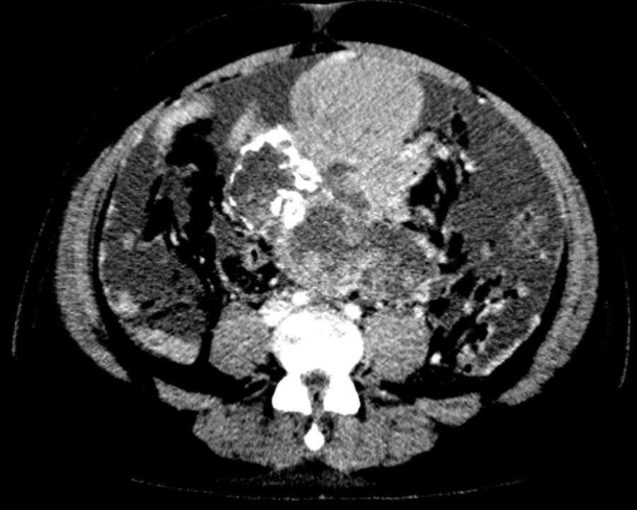 A 41 Year old gentleman with a large abdominopelvic mass and abdominal pain.