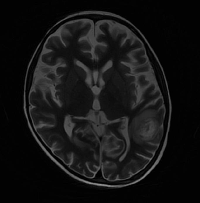 A 55 years old man, presented with complaints of right sided weakness and headache