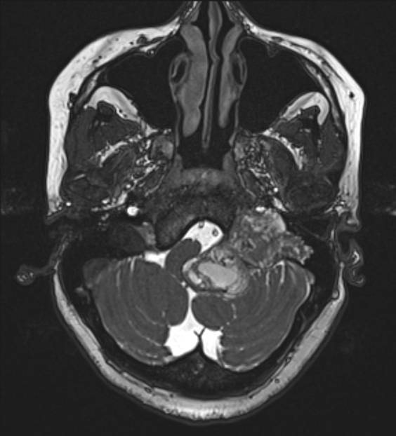42 years old female with chronic headache, difficulty in chewing, swallowing and dysarthria