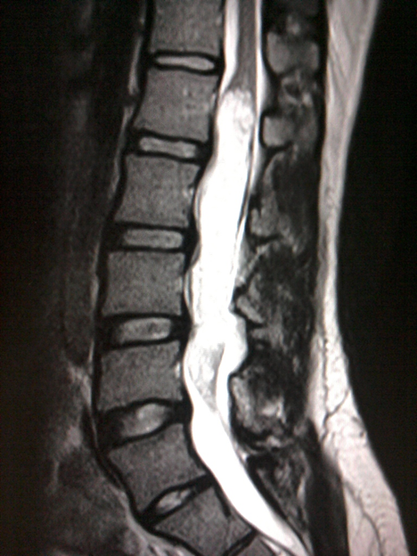 30 years old male with history of low back pain and paresthesia in bilateral lower limb