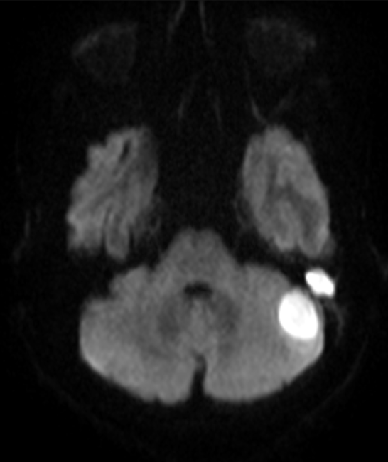 A 27 years old man, presented with complaints fever, headache and seizures