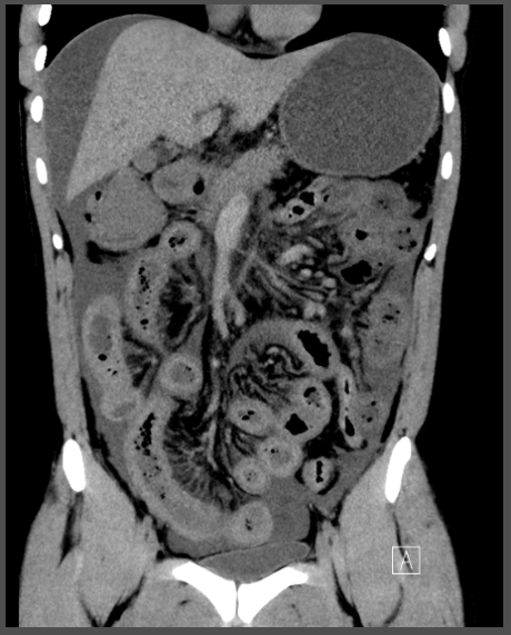28-year-old with the history of abdomen pain with multiple episodes of vomiting.