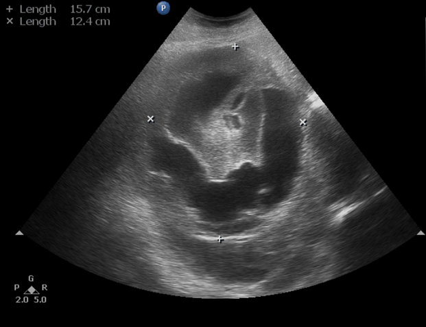 A 25-year-old man with the right sided upper abdominal pain