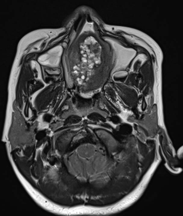 An 11 year old with breathing difficulty and left sided proptosis