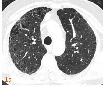65 year-old chronic smoker presented with breathlessness
