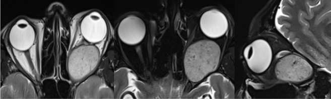 A 26-year gentleman with reduced left sided vision, proptosis and headache