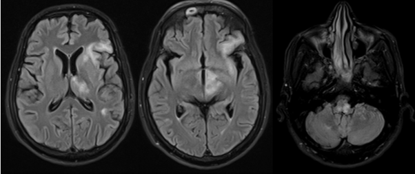 A 41-year gentleman (retroviral positive status) with severe dysarthria/dysphagia, gait ataxia.