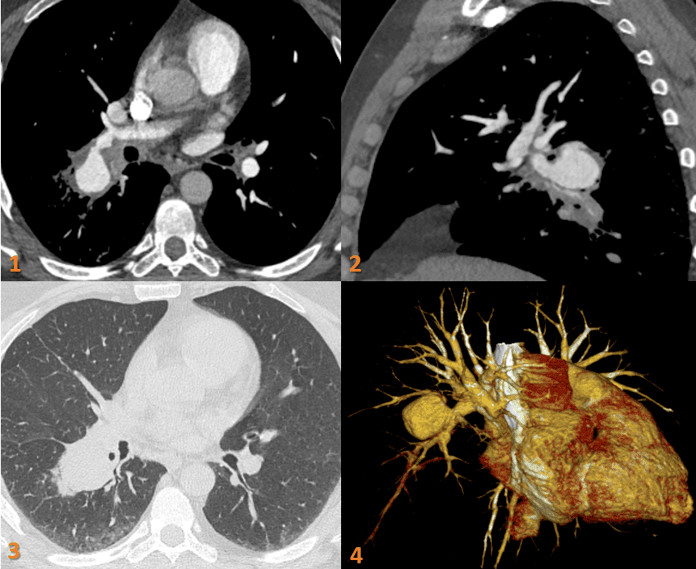 A 43-year gentleman with recurrent hemoptysis, recurrent genital and oral ulcers since 5 years.