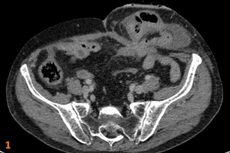A 76-year gentleman with post resection of sigmoid malignancy and descending colostomy. Now complains of abdominal discomfort and low stoma output.