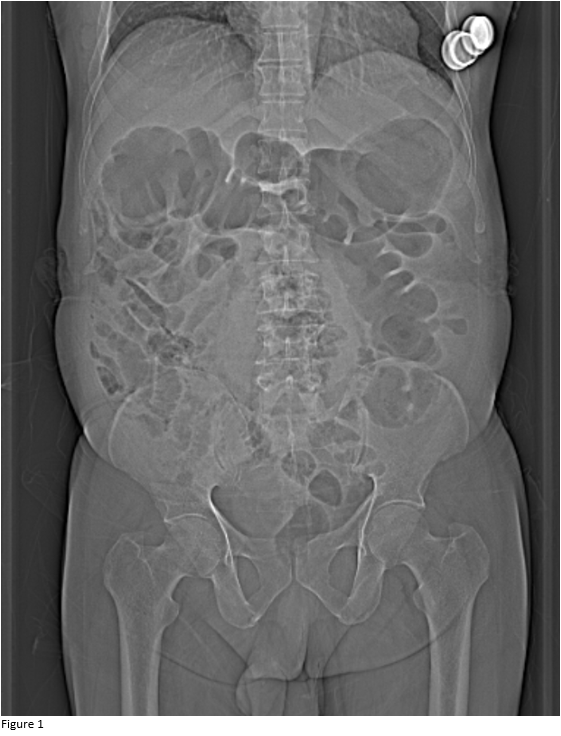 A 58-year old gentleman presenting with constipation since 10 days