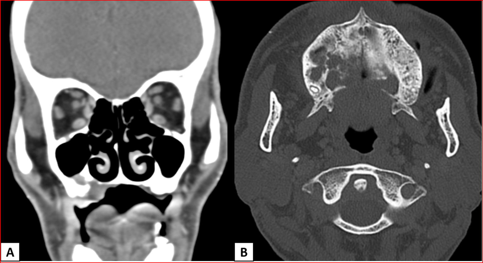 A 65-year-old with the history of right upper alveolus ulcer.