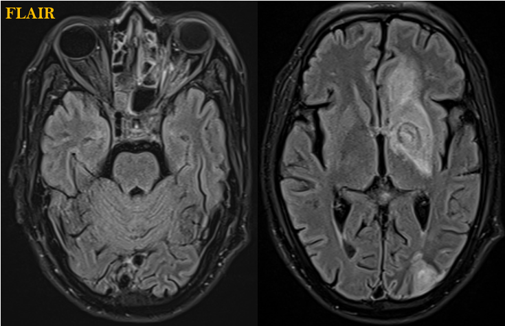 A 38-year-old with the history of fever, cough, right sided weakness, slurring of speech, left sided reduced vision and left facial swelling. Steroid intake history for 20 days.