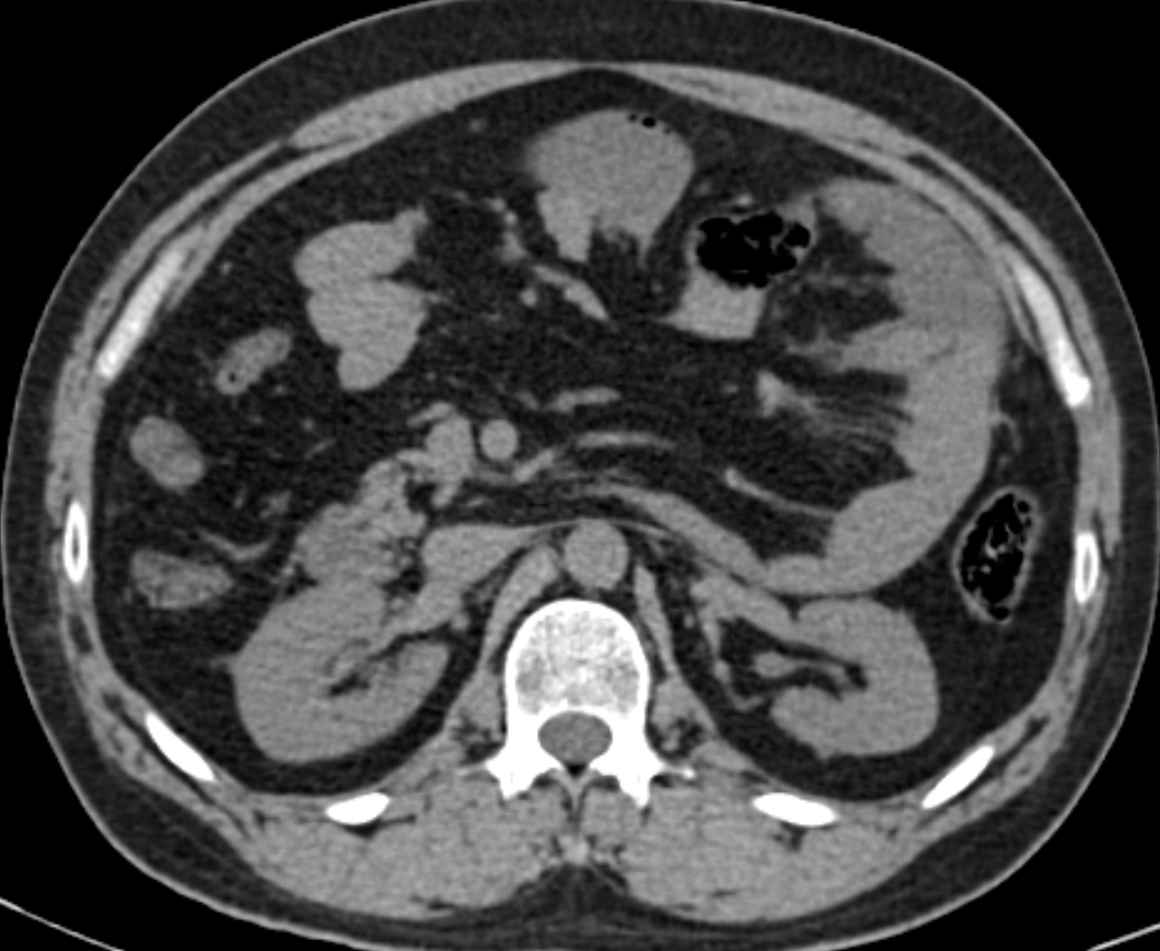 A 38-year-old with the history of epigastric pain with vomiting.