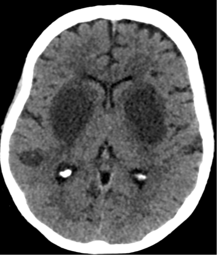 65 yr old known case of renal failure with altered sensorium ,coma and seizures