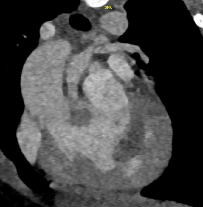 4 month old infant with antenatally detected congenital hear disease, Now presenting with breathlessness