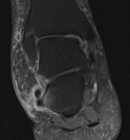 The 73-year-old female is experiencing pain on the lateral aspect of her ankle