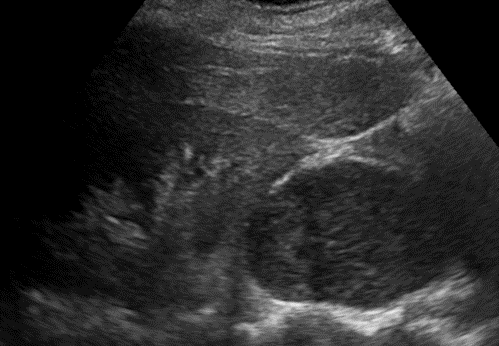A 43 year old female with complains of lump over sacral region in 2015