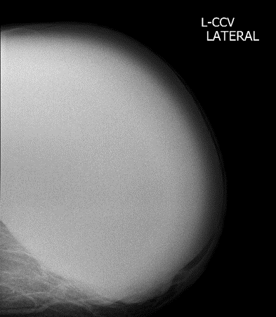 A 75 year old lady with history of left breast lump for 8 years, increasing in size for 2-3 years