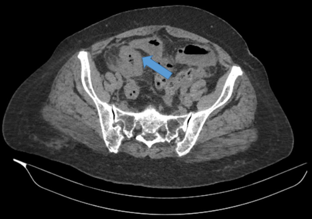 54 year old lady, presented with severe abdominal pain and obstipation for 4 days