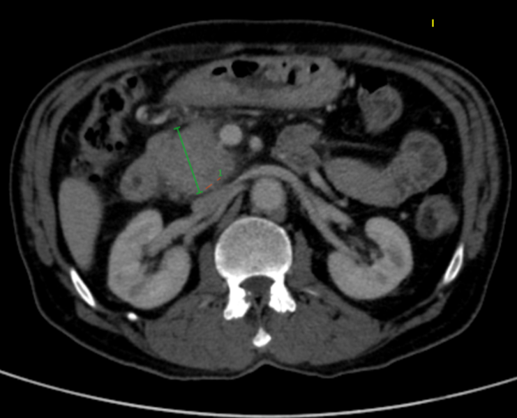 A 66- year- old male presented with complaints of recurrent jaundice, pain in abdomen and fever