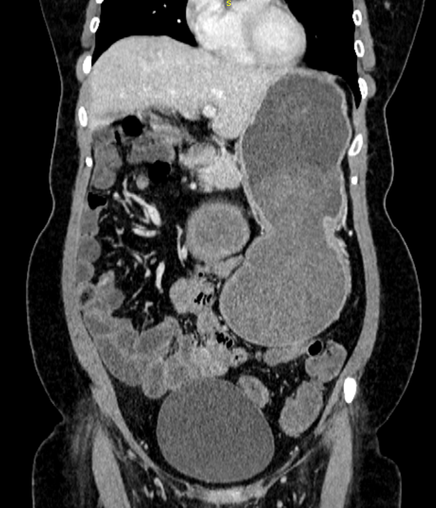 39 years female with complains of heart burn and abdominal distension for one year