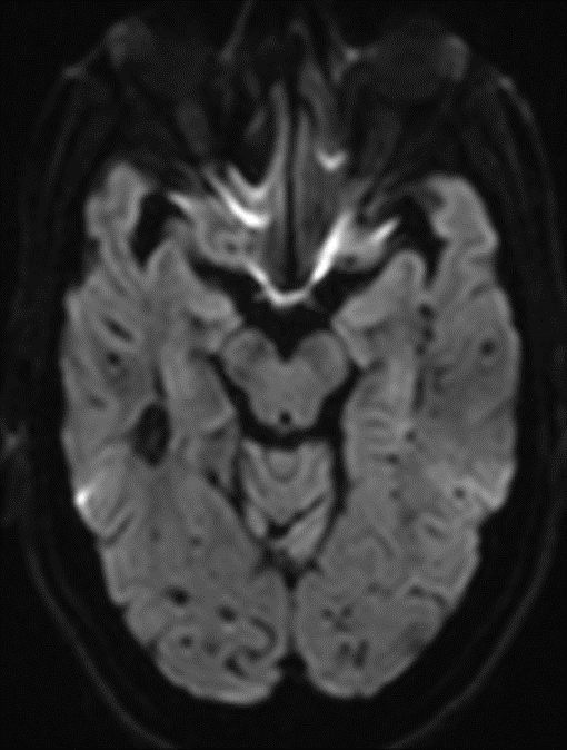 68 year old male, presenting with Chronic headache and giddiness.
