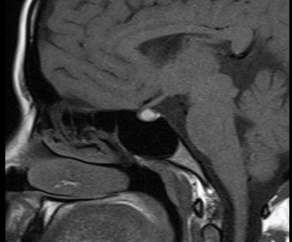 A 27-year-old female presented with complaints of headache