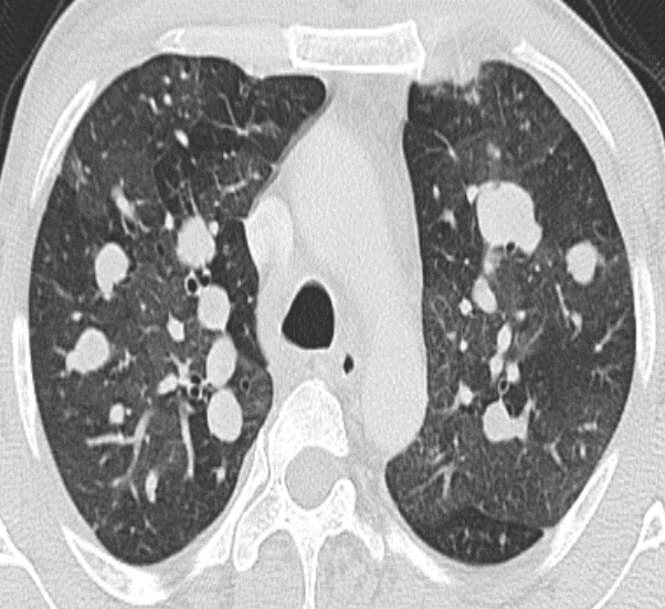 A 47-year-old presented with haemoptysis and cough for one week and breathing difficulties for ten years