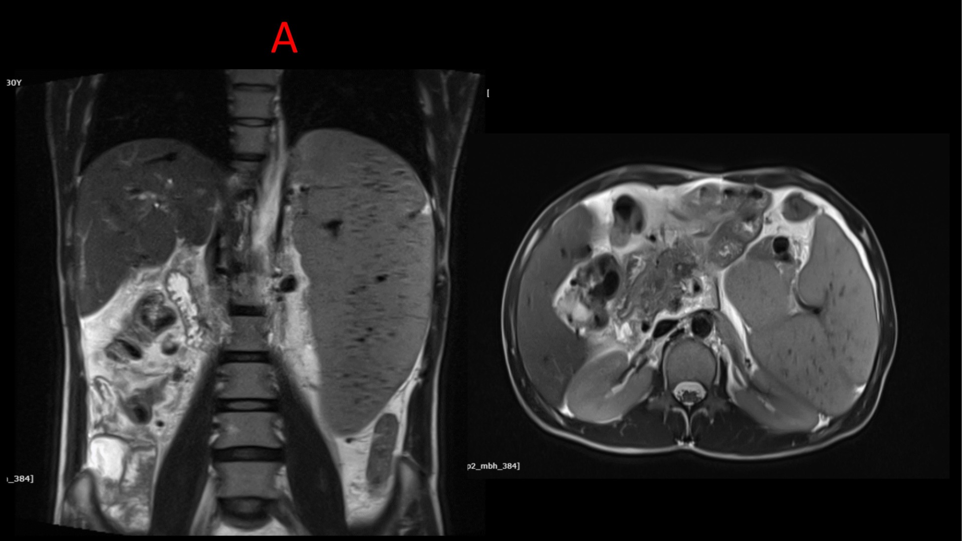 30 year old presented with complaints of abdominal pain , nausea with fever and hematemesis for 2 days