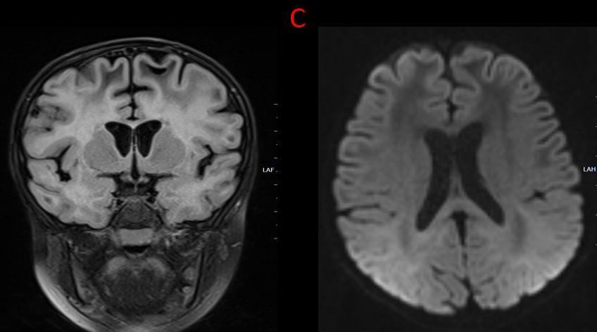 10 yrs old with seizures, motor developmental delay and unsteadiness of gait.