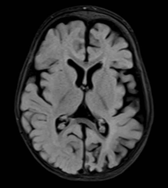 One-year-old female infant presenting with a seizure disorder.