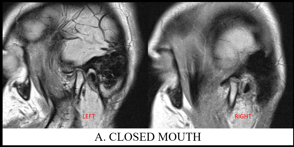 25-year-old with clicking and deviation of jaw for 2 years.
