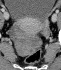 38-year-old lady with complaints of sudden onset right loin to groin pain painful
