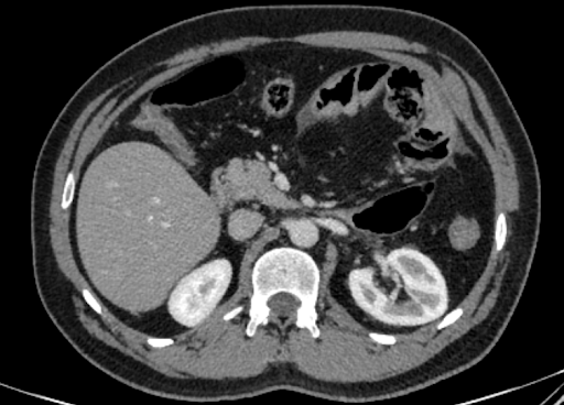 43-year-old with history of pain abdomen and vomiting for 1 day. On medication for H.pylori induced chronic gastritis.