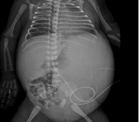 2-day old infant, a DCDA twin, presented with respiratory distress syndrome. Antenatal scan showed a large splenic lesion since early pregnancy, with interval scans showing gradual progressive in size. Mother is an elderly primipara, with previous history