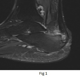 46 year old female, complaints of bony swelling at right calcaneus