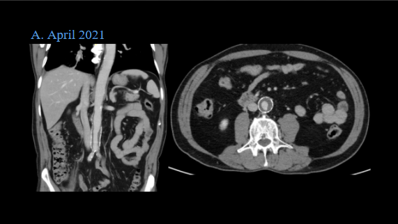A 70 year old gentleman diagnosed with metastatic squamous cell carcinoma