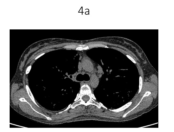 31 year old lady, known case of Sjogren’s syndrome presents with chief complaints of dry cough and shortness of breath for 6 months.