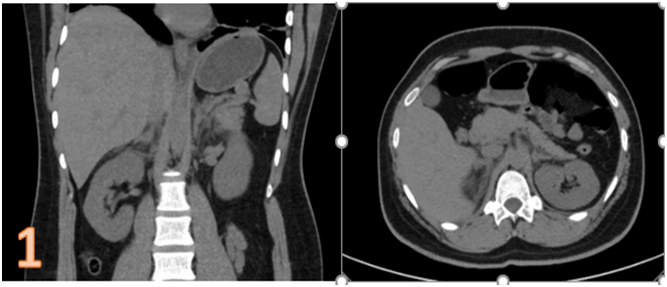28-year-old adult brought to ER with pain at the upper part of the back and upper abdominal discomfort