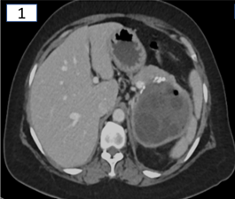 50-year-old gentleman with pain in abdomen and fever for 5 days