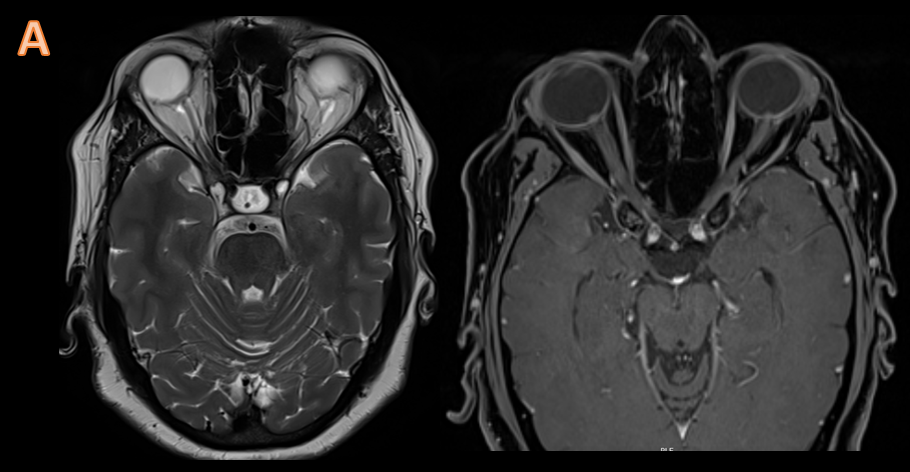 48-year-old female with complaints of  bilateral diminished vision and headache