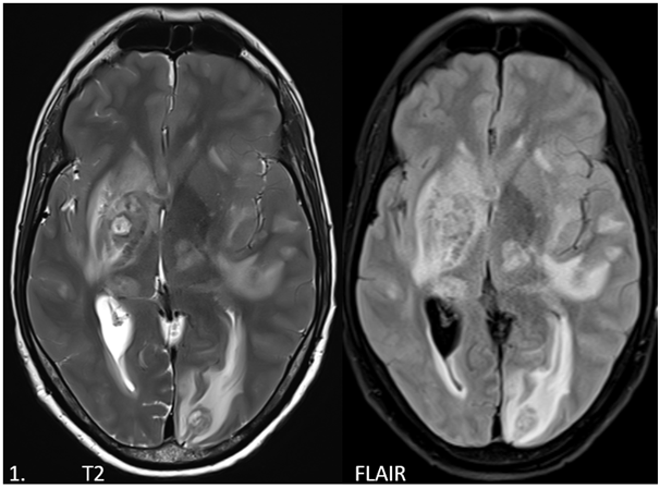 A 36-year-old with history of multiple episodes of seizure