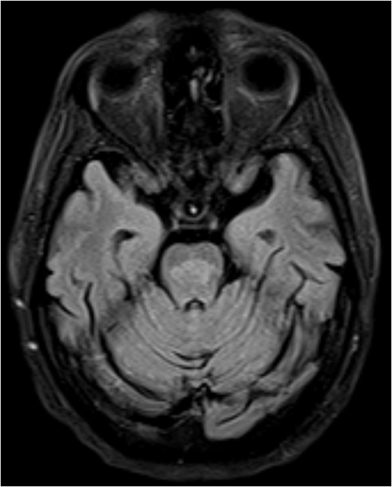 40-year-old male, chronic alcoholic, presented with altered sensorium