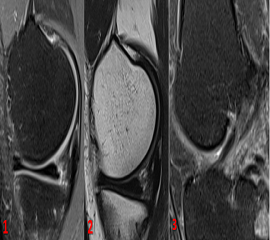 A 40-year gentleman with history of trauma – 3 months back, restricted flexion, posterior knee pain.