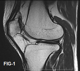 30-year-old gentleman with anterior knee pain from 2 weeks. History of knee injury 1 month back