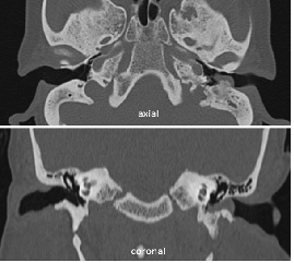 A 60-year-old presenting with complaints of hard of hearing and recurrent episodes of left sided headache.