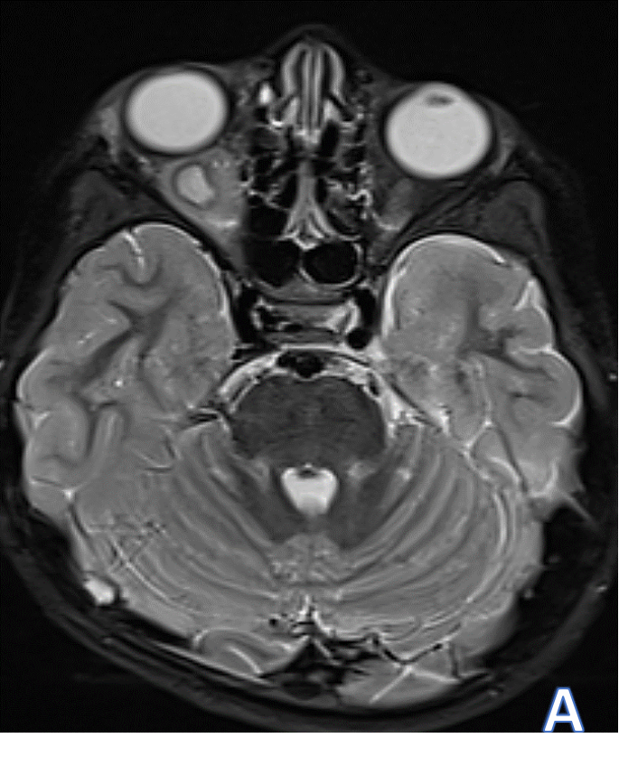 A 4-year-old child with complaints of right eye swelling ,restricted ocular motility and diminished vision since 10 days