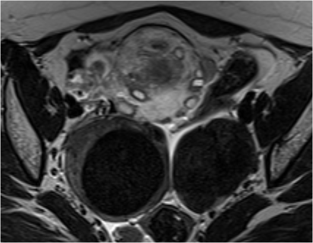 30-year-old female, presented with severe right lower abdominal pain, since 1 day