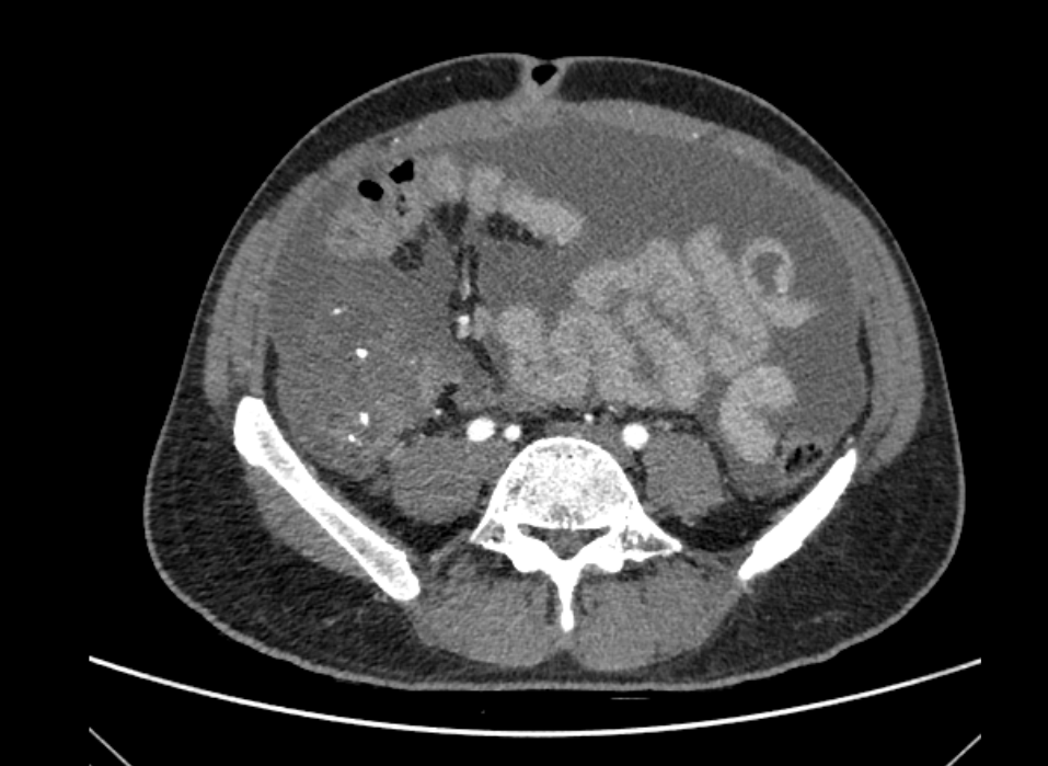 39-year-old male with increased frequency of stools, intermittent bilateral iliac region pain, progressive abdominal distension, and weight loss of 12kgs in the last 4 months
