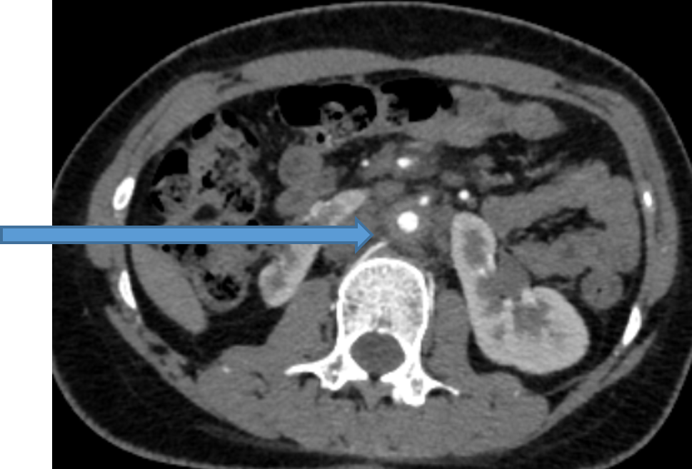25-year-old female with peri-umbilical abdominal pain and weight loss of 8kgs over a period of 1 year